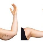 Arm Lift 1