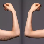 Arm Lift 2