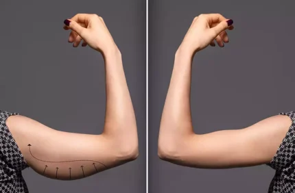 Arm Lift 2