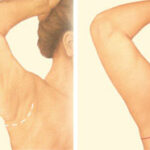 Arm Lift 4