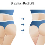 BBL (Brazilian Butt Lift) 2