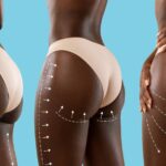 BBL (Brazilian Butt Lift) 4