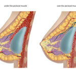 Plastic surgery of breast implants. Vector illustration