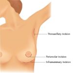 Illustration shows methods of incisions for breast plastic surgery