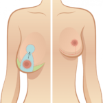 BREAST REDUCTION 1