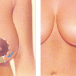 BREAST REDUCTION 2