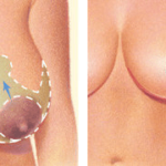 BREAST REDUCTION 3