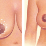 BREAST REDUCTION 4