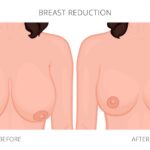 BREAST REDUCTION 5