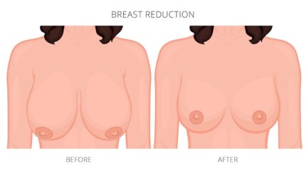 BREAST REDUCTION 5