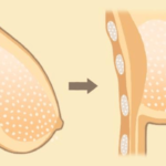 BREAST UPLIFT 1