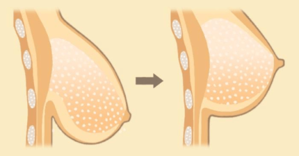 BREAST UPLIFT 1
