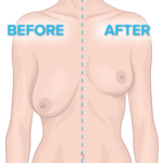 BREAST UPLIFT 2