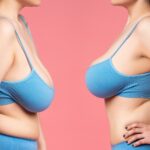 BREAST UPLIFT 3
