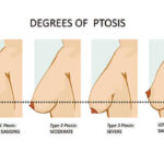BREAST UPLIFT 4