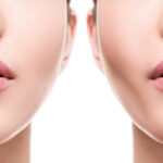 Female,Face,Comparison,After,Successful,Buccal,Fat,Extraction,Plastic,Surgery