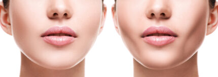 Female,Face,Comparison,After,Successful,Buccal,Fat,Extraction,Plastic,Surgery
