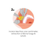 Bichectomy 5