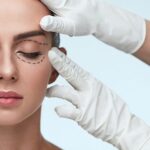 Blepharoplasty 1