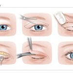 Blepharoplasty 2