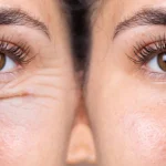 Blepharoplasty 3