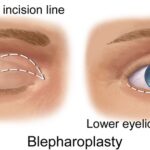 Blepharoplasty 4