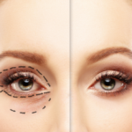 Blepharoplasty 5