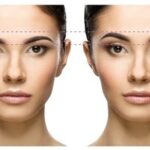 Brow Lift 1