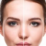 Brow Lift 2