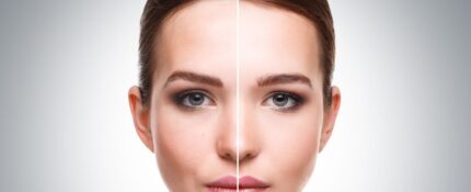 Brow Lift 2 Brow Lift 2