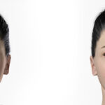 Brow Lift 3