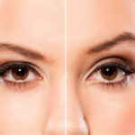 Brow Lift 4