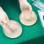 Butt Implants 2