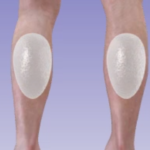 Calf Implants 1