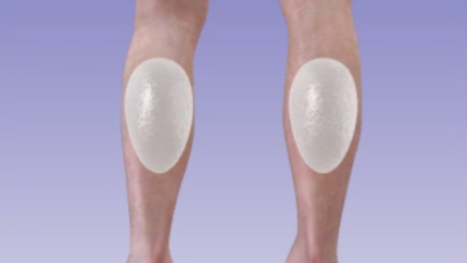 Calf Implants 1