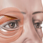 Cantoplasty 1