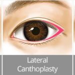 Cantoplasty 2