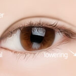 Cantoplasty 4