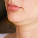 Chin Liposuction 1