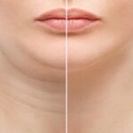 Chin Liposuction 2