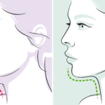 Chin Liposuction 5