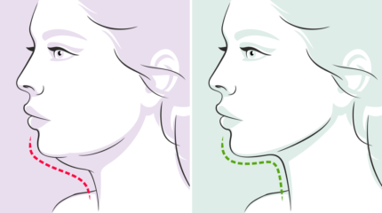 Chin Liposuction 5