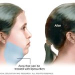 Chin Liposuction 6