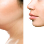 Chin Liposuction 7