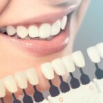 Emax Veneer Crown 2