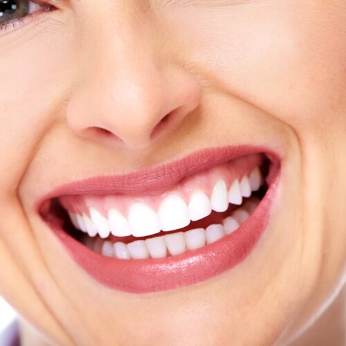 Emax Veneer Crown 3