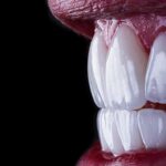 Emax Veneer Crown 4