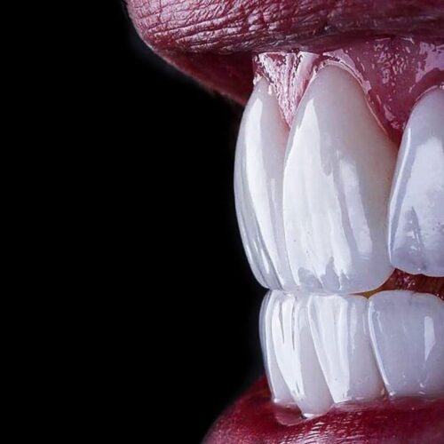 Emax Veneer Crown 4