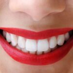 Emax Veneer Crown 5