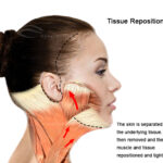 Facelift 1